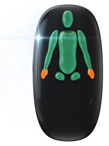 Absence of both legs just below the hips with movement affected to a moderate degree in the hands